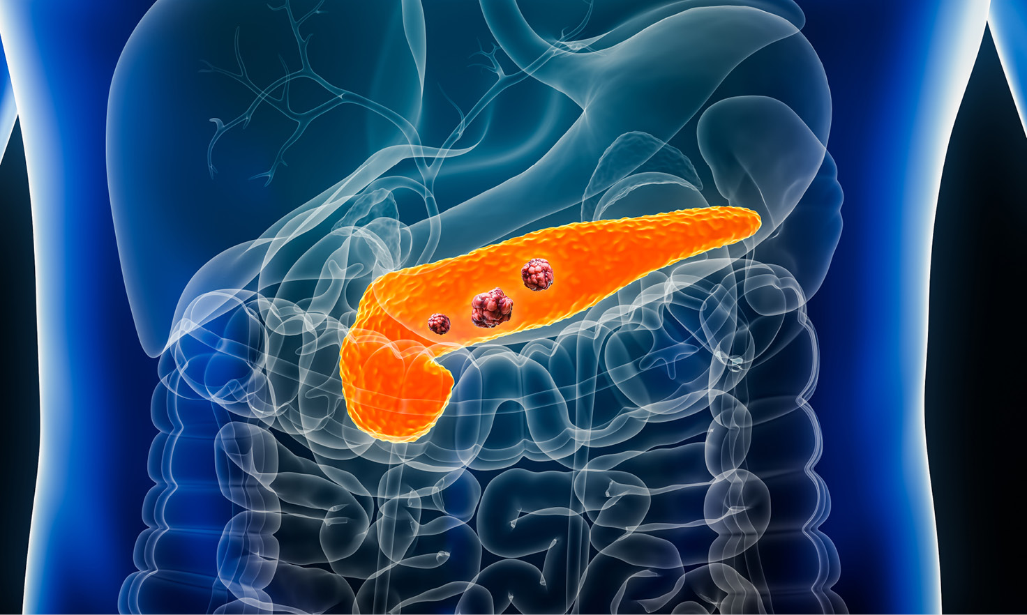 Pancreatic cancer forms when cells grow out of control and create a tumor. It is hard to spot early because it may not cause any signs or symptoms. 