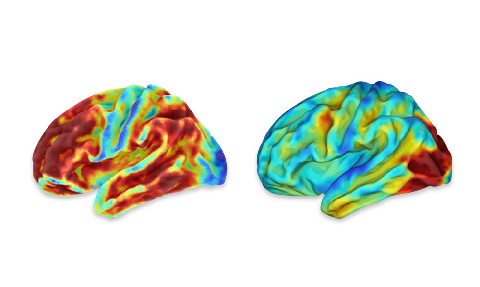 Brain images of a woman with an inherited condition that causes early-onset Alzheimer’s disease. 