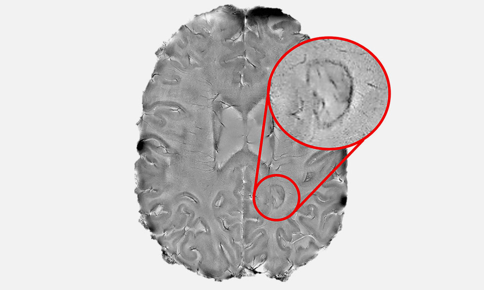 Dark-rimmed spots on the brain, like this one, may suggest a more severe form of multiple sclerosis and help with early detection. 