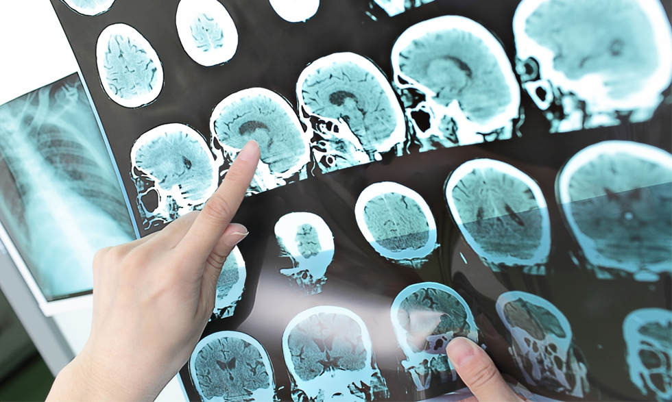 An MRI can help diagnose multiple sclerosis. 