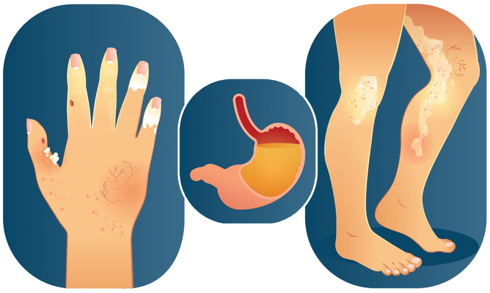 Scleroderma can lead to painful bumps under the skin, red spots, patches of hard skin, and even digestive problems. 