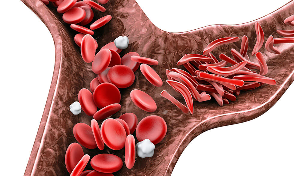 Sickle-shaped cells are not flexible and can stick to vessel walls, causing a blockage. 